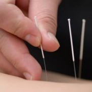 Dry Needling